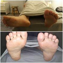 Asiakkaan jalat ennen ja jälkeen