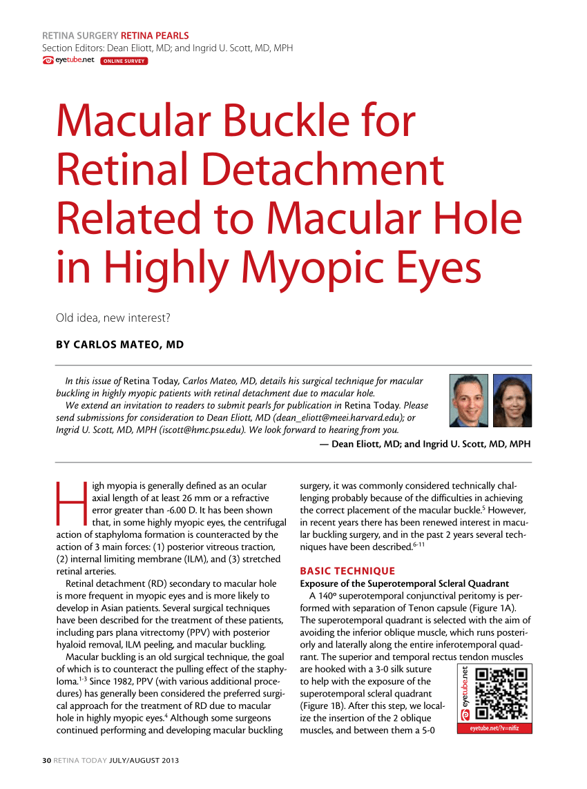 Macular buckle Retina Today article