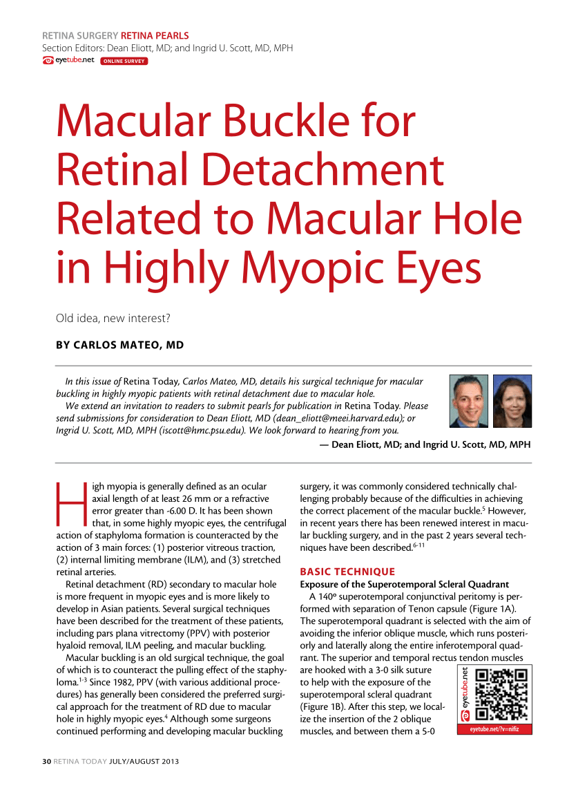 Macular Buckle Retina Today article 